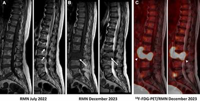 Case report: When infection lurks behind malignancy: a unique case of primary bone lymphoma mimicking infectious process in the spine